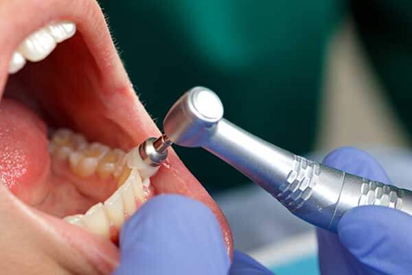 Close Up of Teeth Being Cleaned in Dental Office