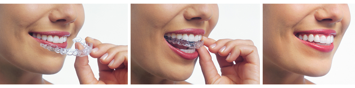 Invisalign® clear aligner