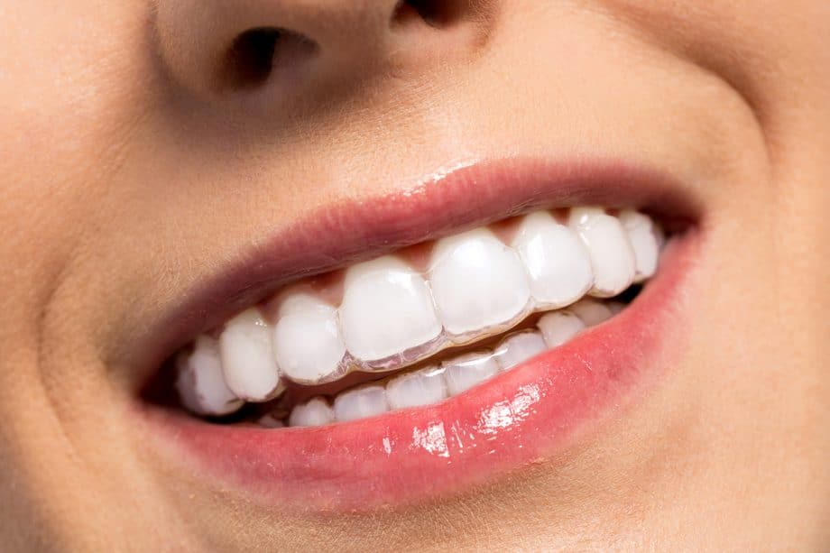 How Do Clear Aligners Work and Are They Right for You?