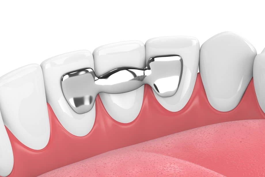 How Long Do Dental Bridges Last?