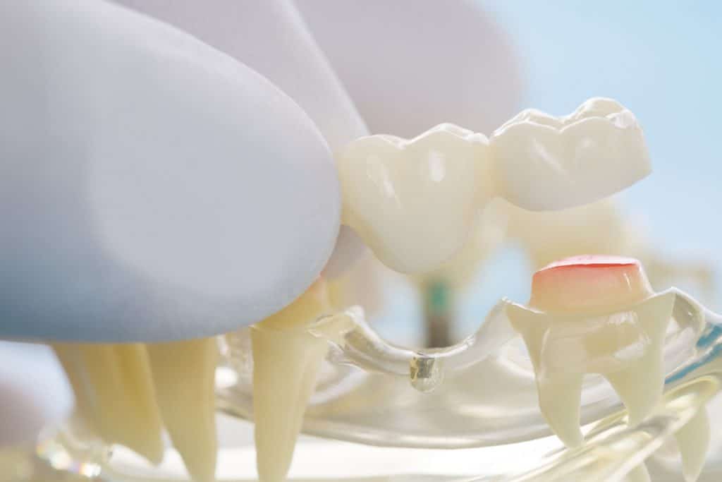 How Long Does It Take For A Dental Bridge To Settle Suwanee GA