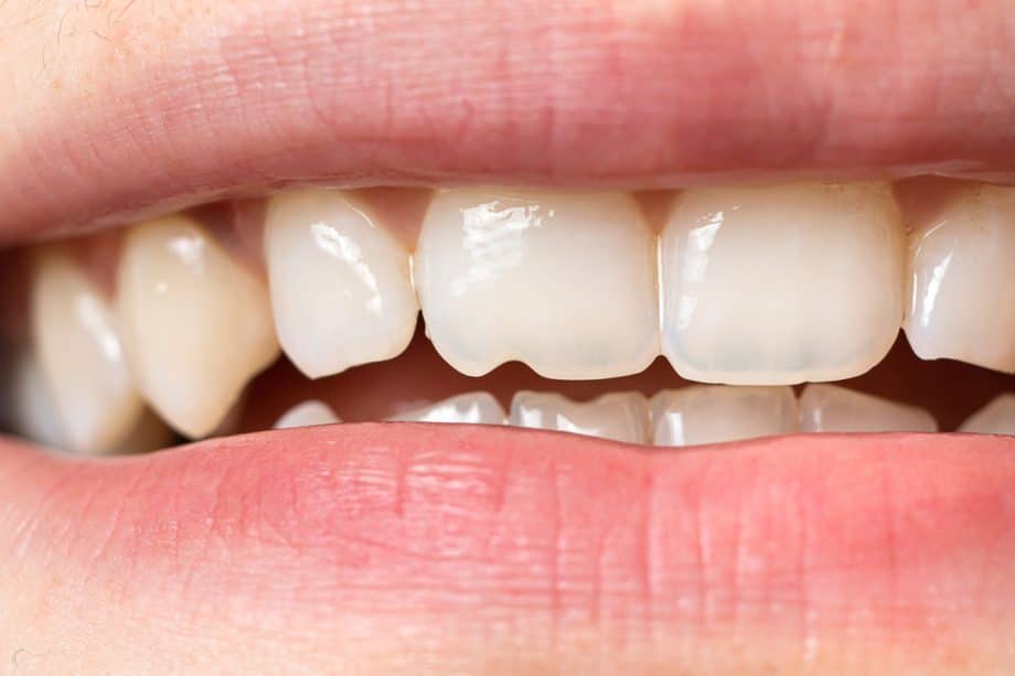 What to Do If You Chip a Tooth Playing Sports in Suwanee