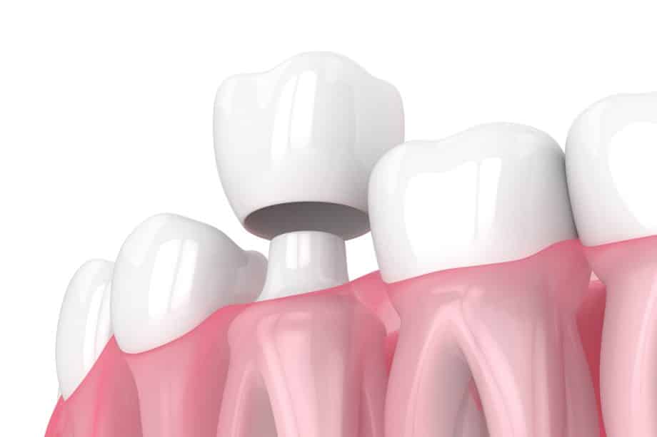 What to Do If Your Dental Crown Cracks or Falls Off